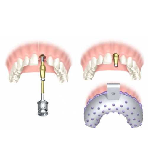 Nobel Bio Care leczenie implantologiczne braku pojedynczego zęba