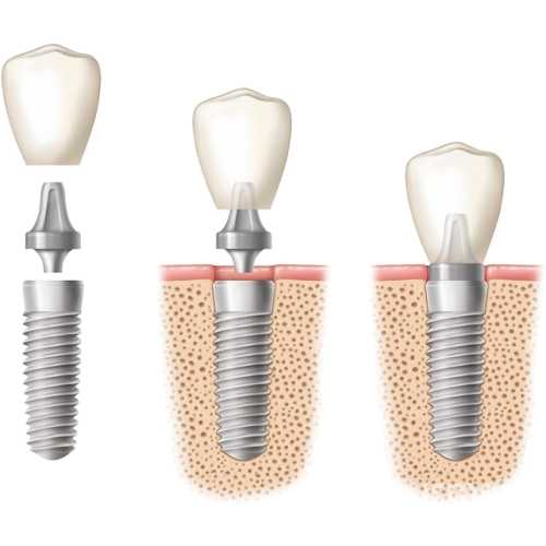 Nobel Bio Care implant zębowy